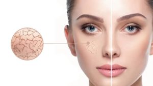 تفاوت پوست خشک و پوست دهیدراته چیست