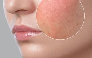 پوست خشک چرب مختلط نرمال